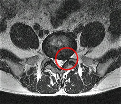 저 원 안 부위만 균형을 읽고 돌출되어 있습니다. 병원에 요구하면 MRI 촬영 사진을 CD로 구워 줍니다. 비용은 1만 원입니다. 